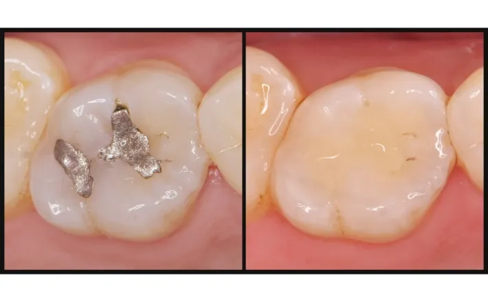自費と保険の補綴物の違い