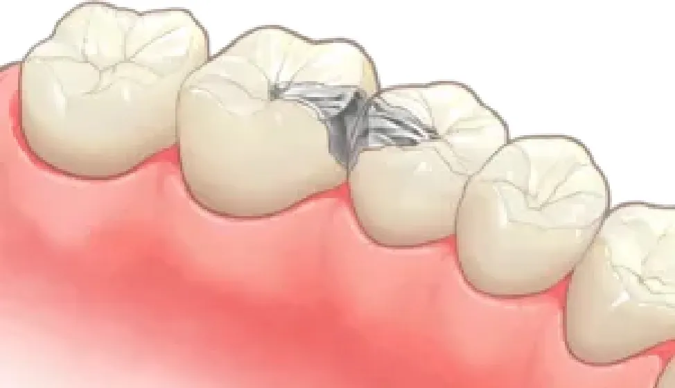 メタルインレー