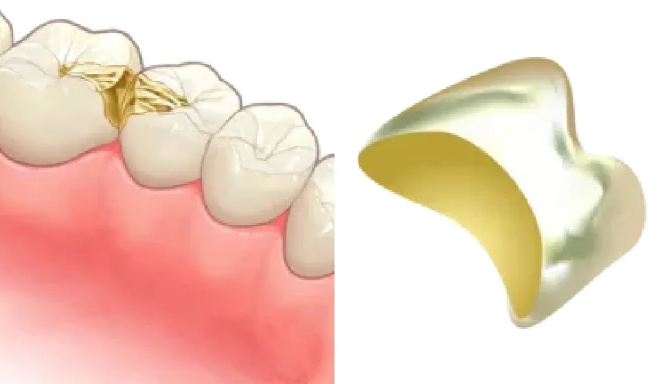 ゴールドインレー・ゴールドクラウン