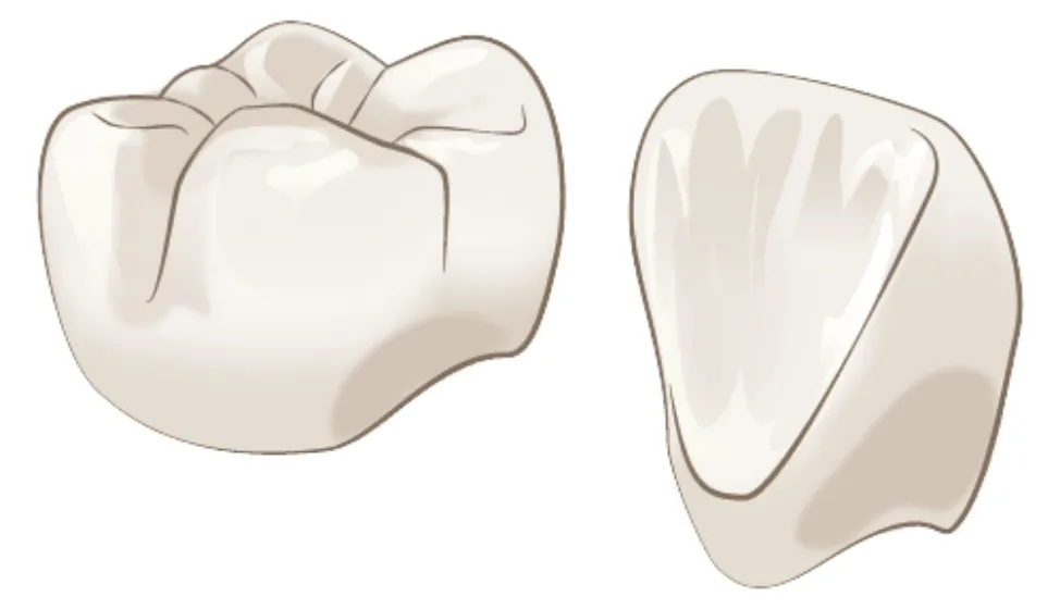 オールセラミック