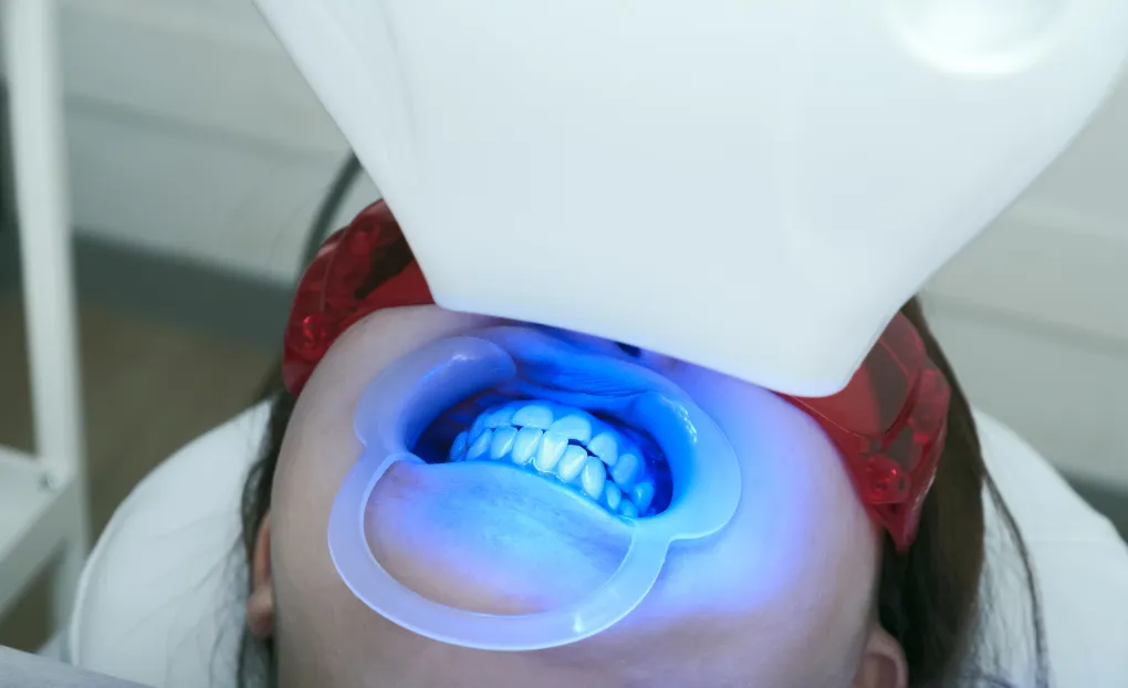 オフィスホワイトニング