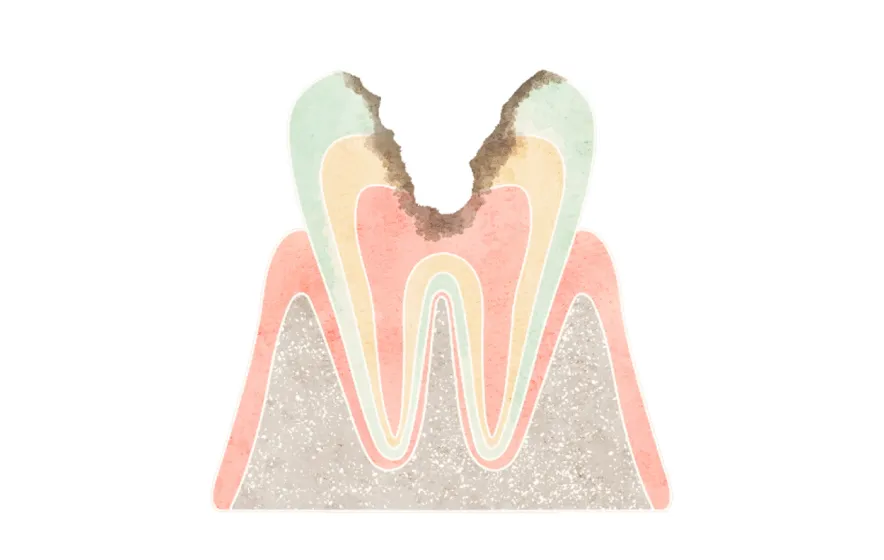 虫歯が神経まで達している状態