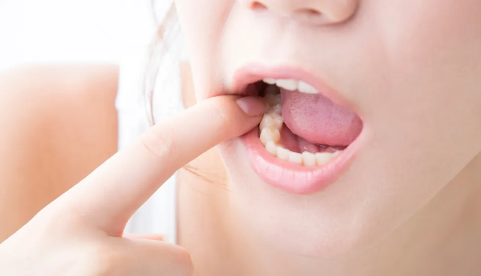 ホルモンの影響で歯周病になりやすい