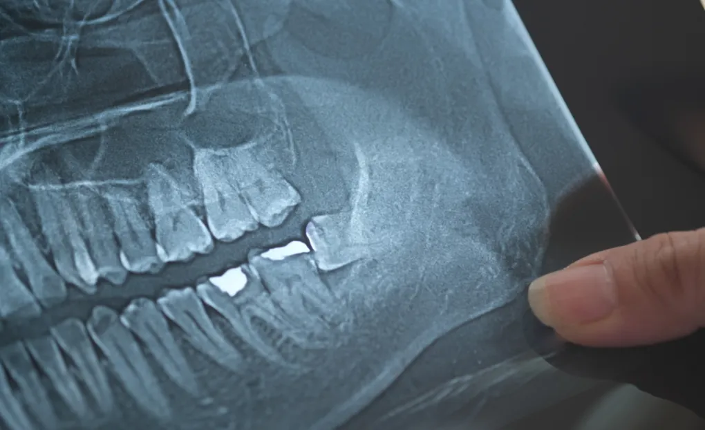 親知らずの抜歯治療