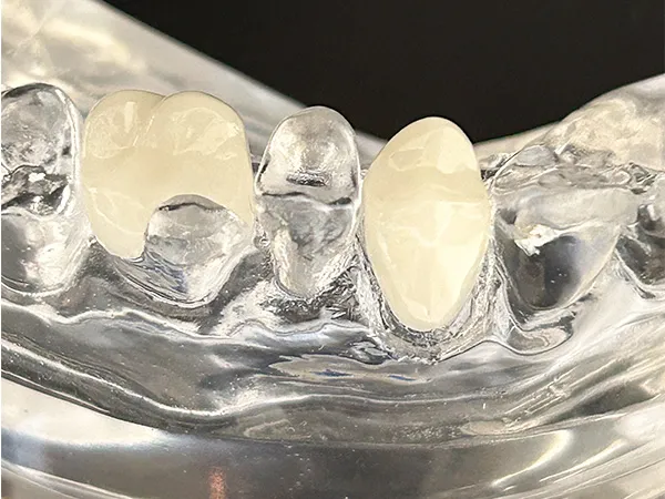 補綴治療の種類