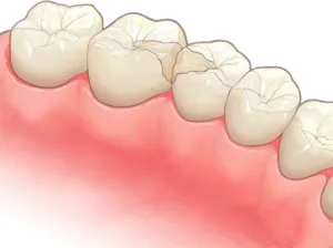 コンポジットレジン